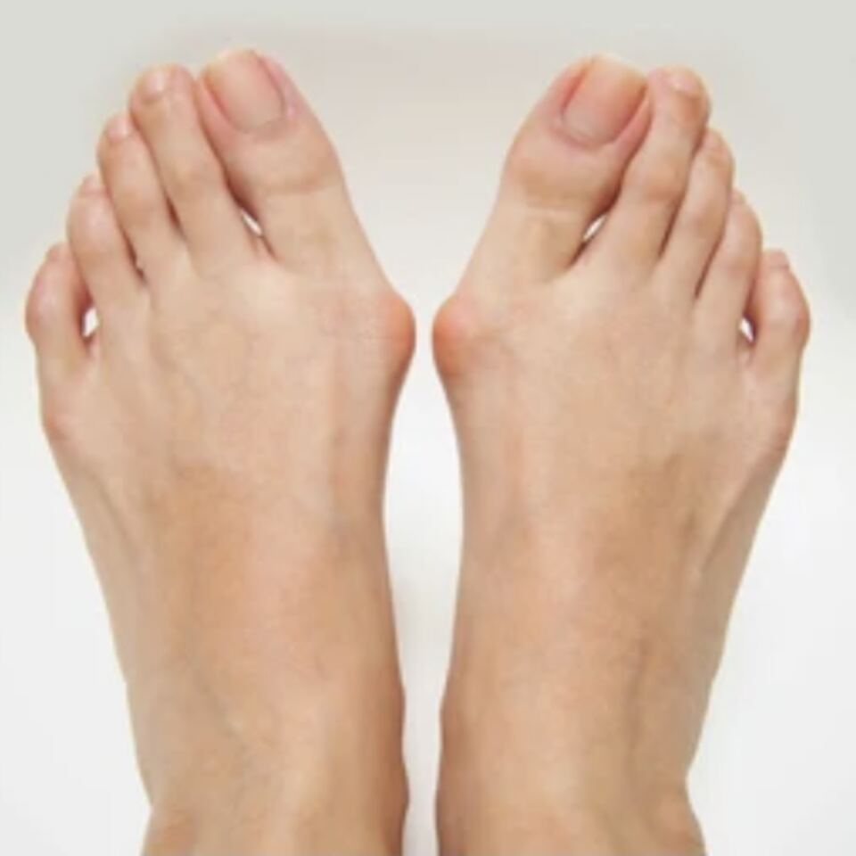 Bunions