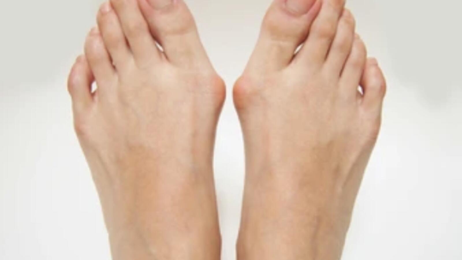 Bunions