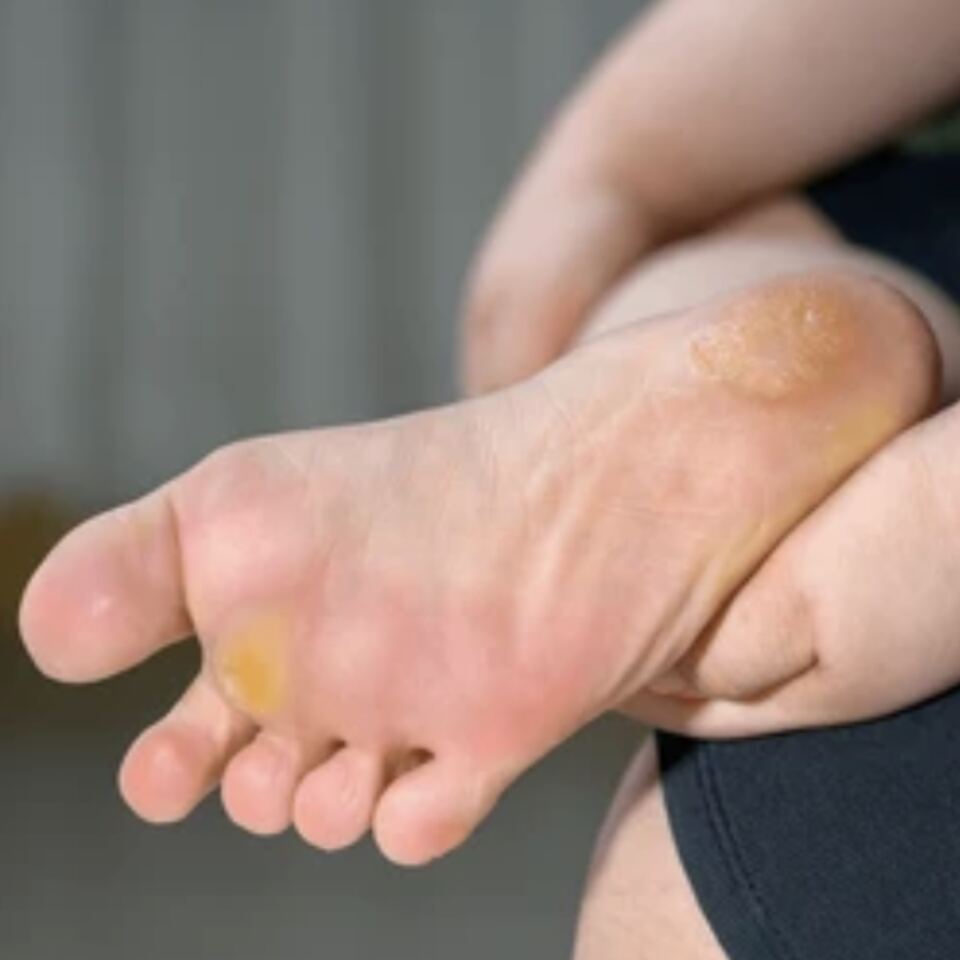 Corns & Calluses