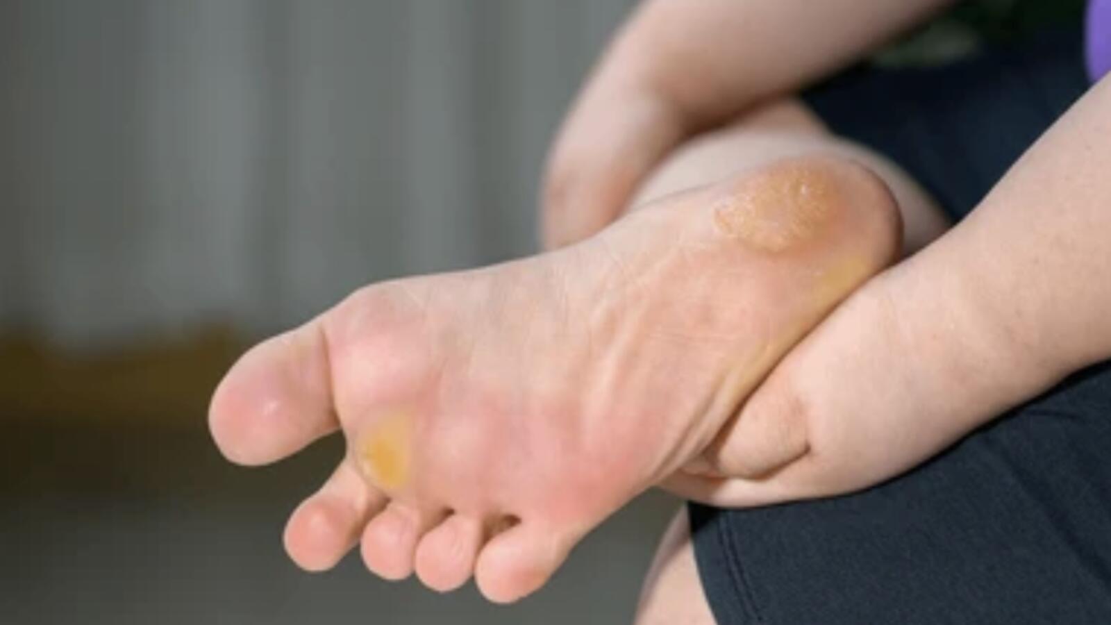 Corns & Calluses
