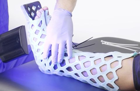 Introducing FlexiOH: The Waterproof Cast Now Available at Vertex Podiatry in Columbus