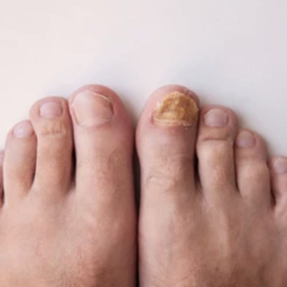 Hongos en las Uñas: Por Qué los Tratamientos de Venta Libre Suelen Fallar