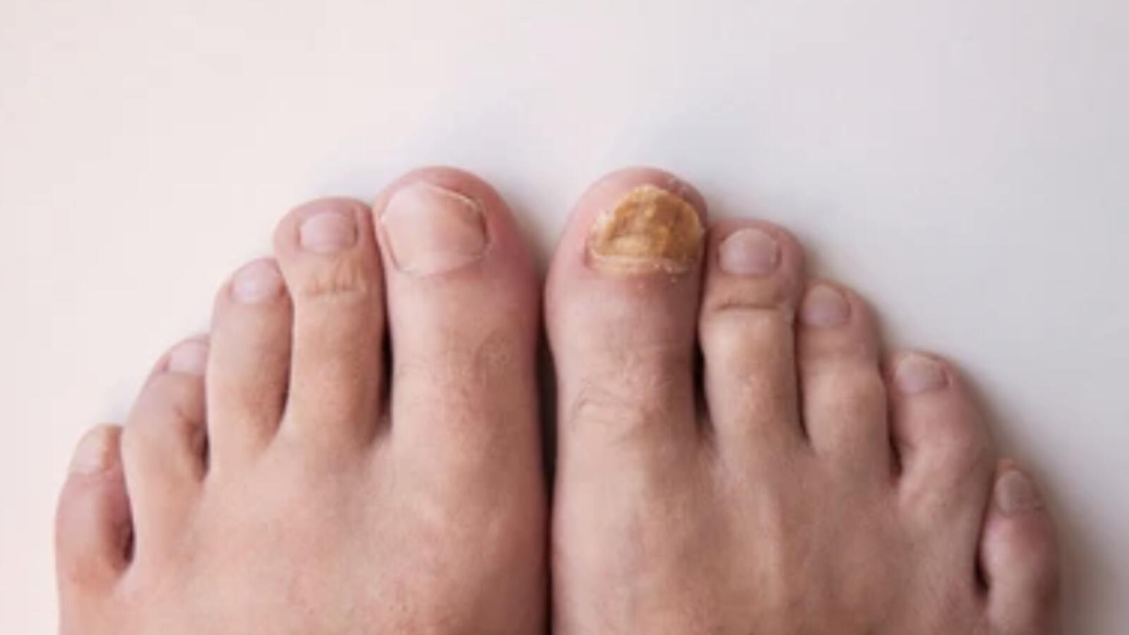 Fungal Toenails