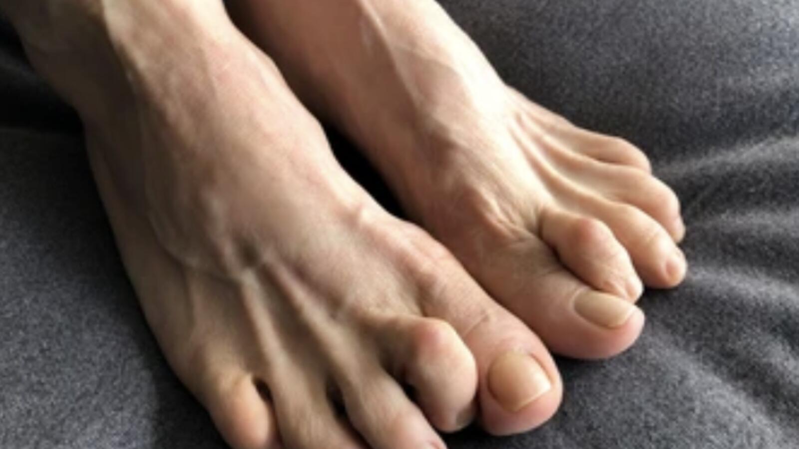 Hammer Toes