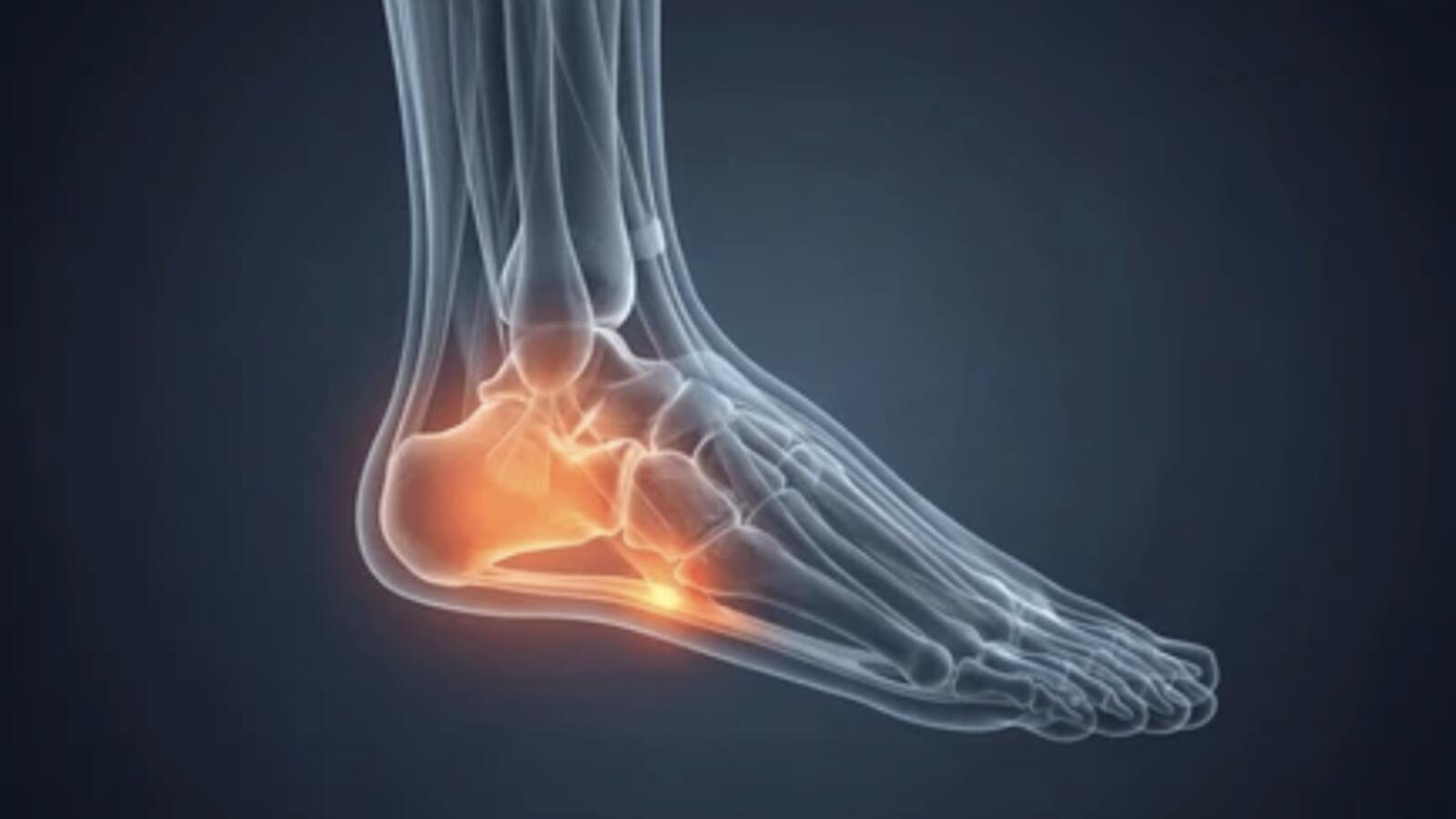 Heel Pain & Plantar Fasciitis