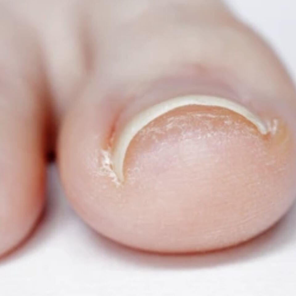 Uñas Encarnadas: Cuándo Tratar en Casa y Cuándo Ver a un Médico