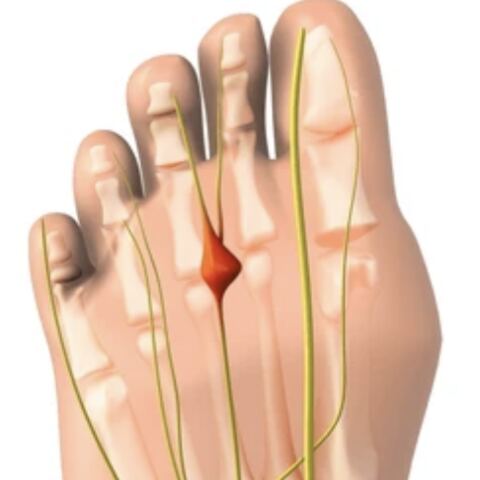 Morton's Neuroma: Why the Ball of Your Foot Burns and What to Do About It