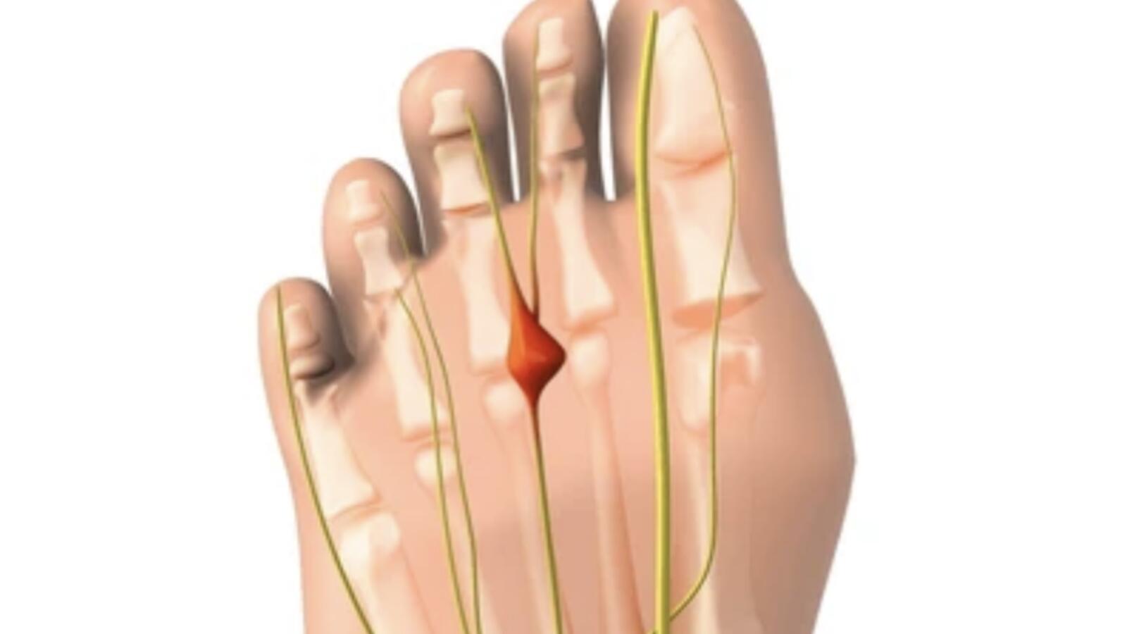 Neuromas (Morton's Neuroma)