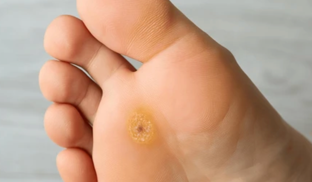 Plantar Warts: How Contagious Are They Really?
