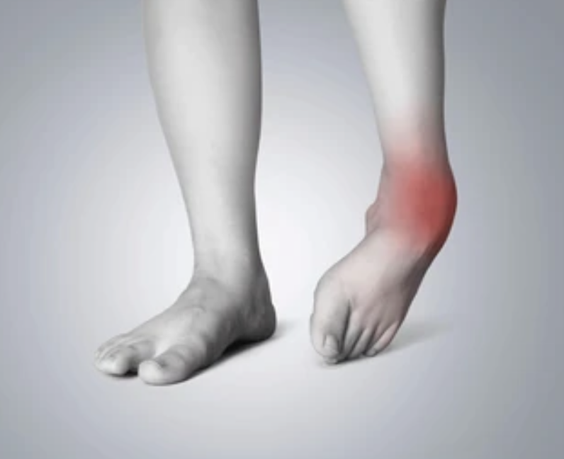 My Ankle Sprain Won't Heal: When to Stop Waiting and See a Specialist