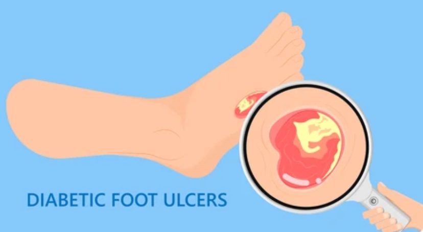 Prevención de Úlceras en el Pie Diabético: Lo Que Toda Persona con Diabetes Debe Saber