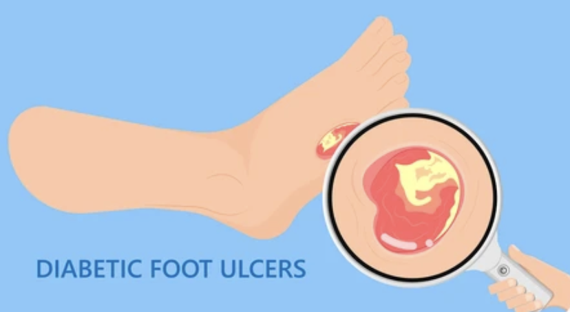 Preventing Diabetic Foot Ulcers: What Every Person with Diabetes Must Know