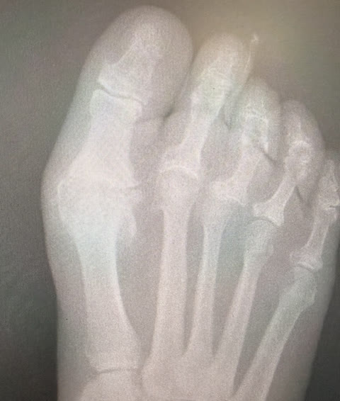 First MTP Joint Osteoarthritis: Reduced Big Toe Motion and Treatment Options