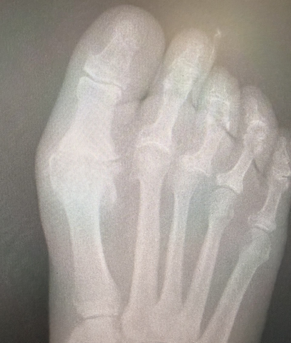 First MTP Joint Osteoarthritis: Reduced Big Toe Motion and Treatment Options