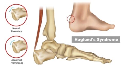 Deformidad de Haglund: Tratamiento Conservador vs. Cirugía y Recuperación