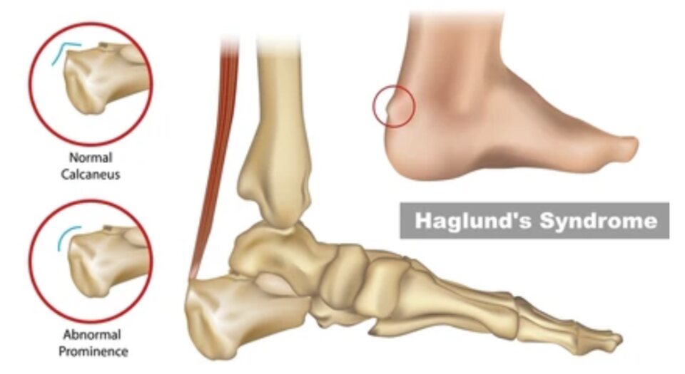 Haglund’s Deformity: Conservative Treatment vs. Surgery and Recovery