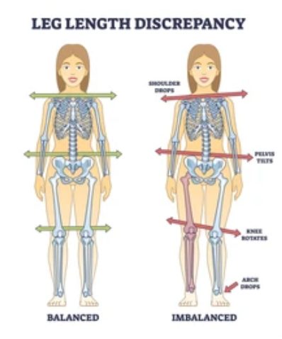 Limb Length Discrepancy: How a Short Leg Travels All the Way to Your Foot