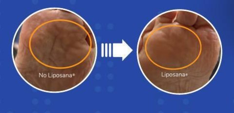 Walking on Bone? Fat Pad Atrophy and How Liposana May Help