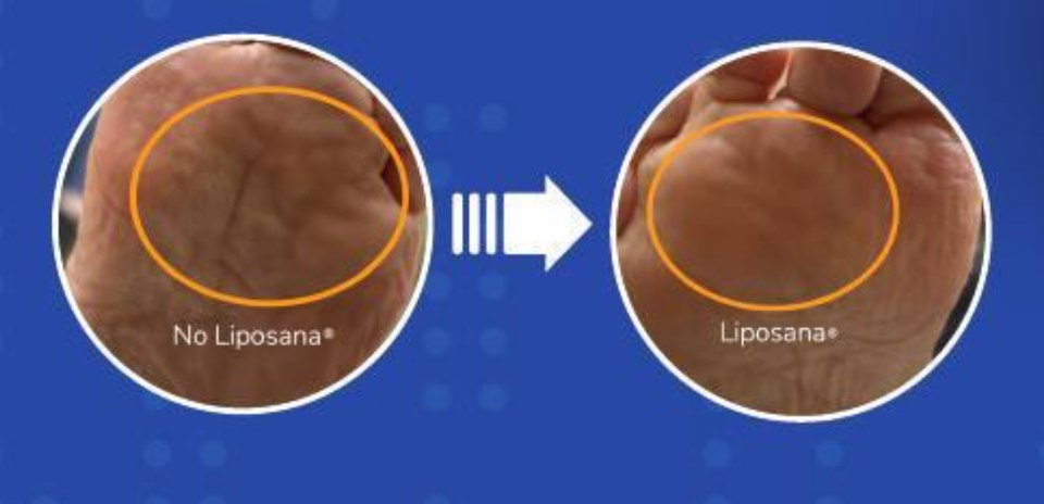 Supplied Liposana comparison graphic showing two views of the ball of a foot, labeled No Liposana and Liposana, with the cushioning areas circled.