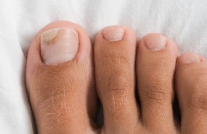 Close-up of toenails with a discolored area near the edge of the big toenail, provided to illustrate nail changes.