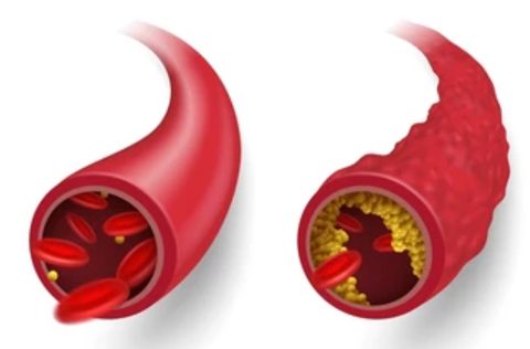 Peripheral Arterial Disease (PAD) in the Foot: ABI & TBI Screening in Columbus, Ohio