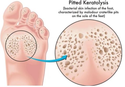 Queratólisis Punteada: ¿Qué Causa los Hoyuelos y el Mal Olor en los Pies?