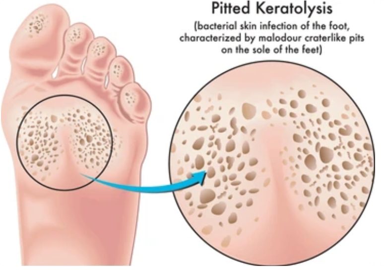Queratólisis Punteada: ¿Qué Causa los Hoyuelos y el Mal Olor en los Pies?