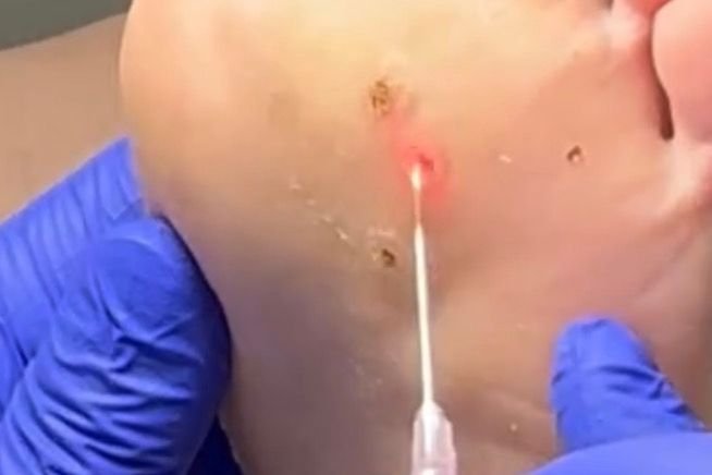Laser treatment of a plantar wart on the sole of a foot, with gloved hands supporting the foot and guiding the laser.