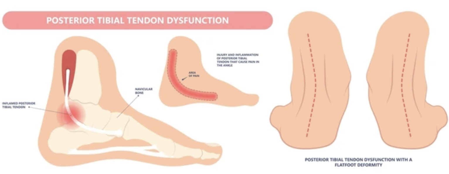 PTTD: Why Your Arch Is Collapsing and What Custom Orthotics Can Do About It